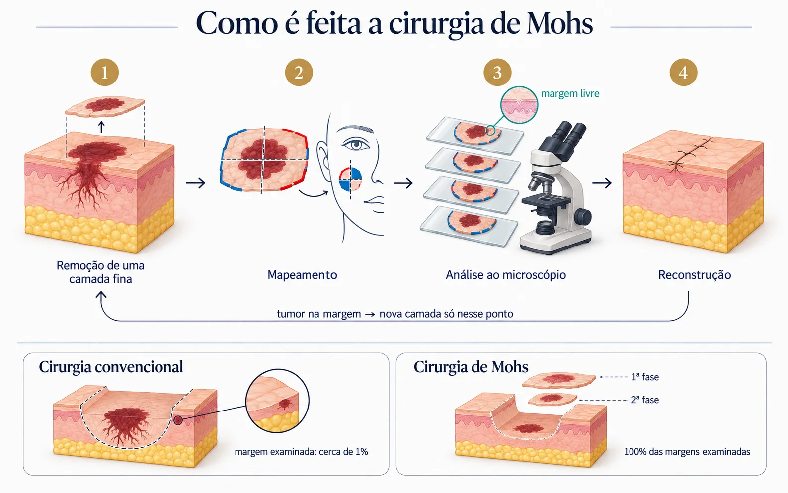 Etapas da cirurgia de Mohs: remoção, mapeamento, análise ao microscópio e reconstrução