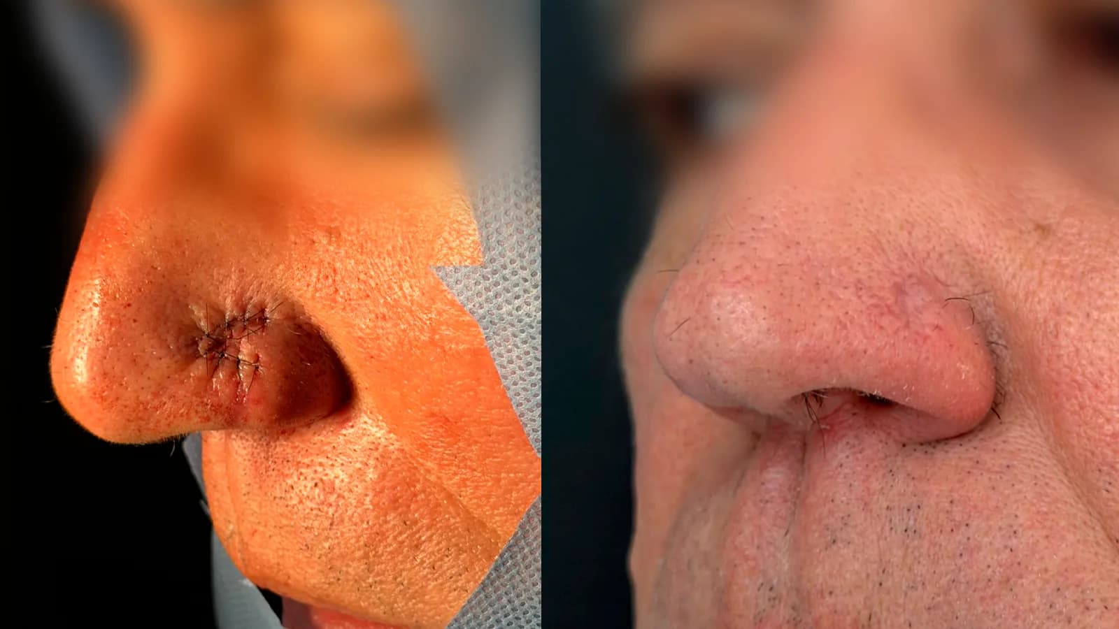 Linha do tempo do pós-operatório da cirurgia de Mohs
